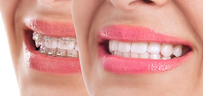 Almaden Valley Smile Design | Dental Cleanings   Exams, Extractions and Veneers