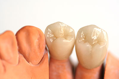 Almaden Valley Smile Design | Dental Fillings, Dentures and All-on-6 reg 
