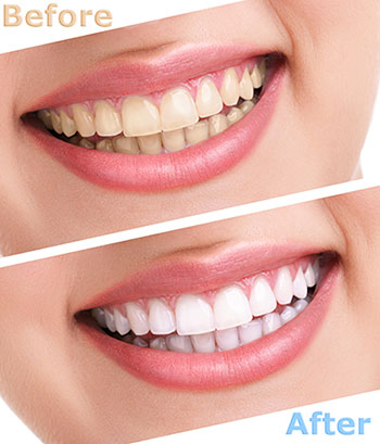 Almaden Valley Smile Design | Smile Makeover, Teeth Whitening and Dentures