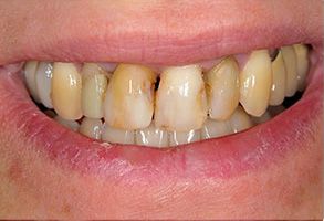 Almaden Valley Smile Design | Full Mouth Reconstruction, Root Canals and Crowns  amp  Bridges