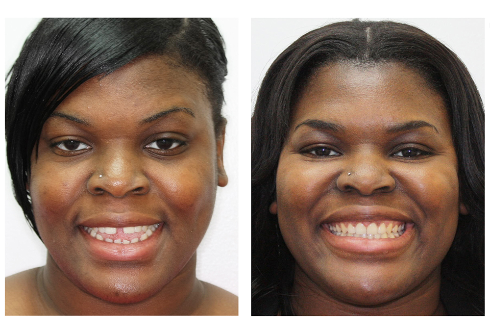 invisalign before after
