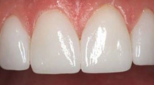 Teeth Cleaning in Cambrian Park